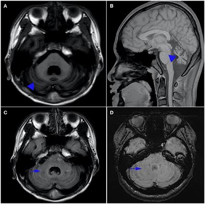 Case report: A novel APTX p.Ser168GlufsTer19 mutation in a Chinese family with ataxia with oculomotor apraxia type 1